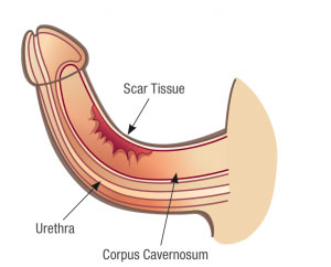 Crooked Peyronie's Curve